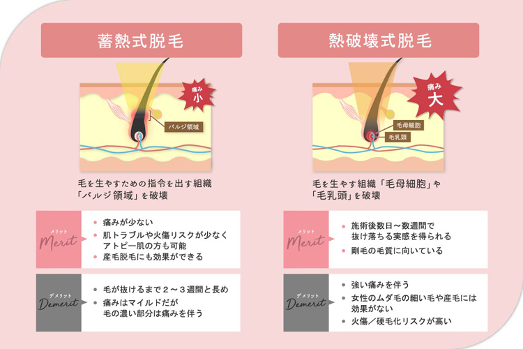 蓄熱式と熱破壊式の脱毛方法と仕組みの違いを説明